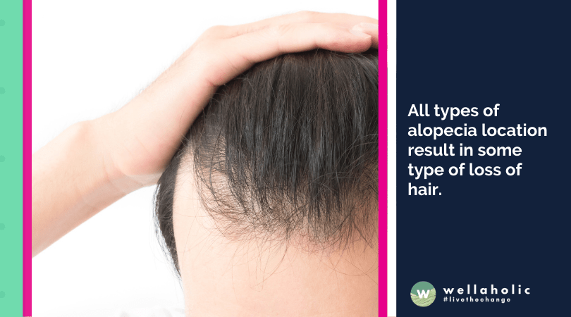 All types of alopecia location result in some type of loss of hair. 