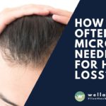 how-often-micro-needling-for-hair-loss_orig