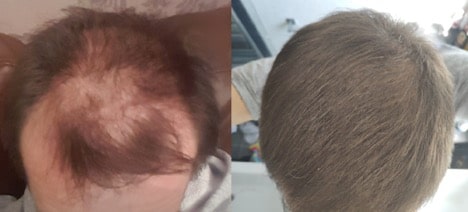 reddit microneedling hair growth min orig