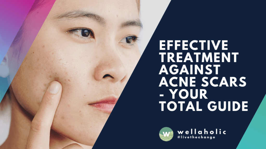 Effective treatment against Acne Scars - Your total guide