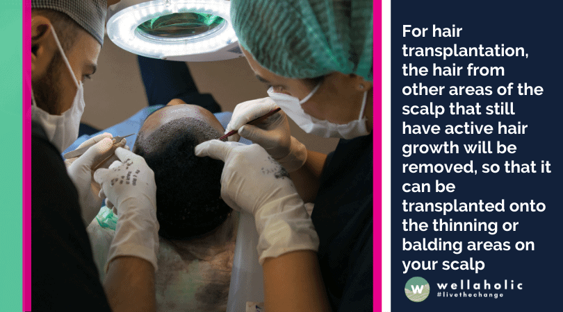 For hair transplantation, the hair from other areas of the scalp that still have active hair growth